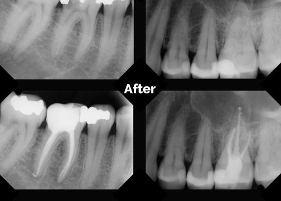 Root canal B & A